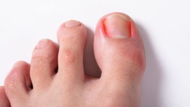 Ingrown Toenail Surgery