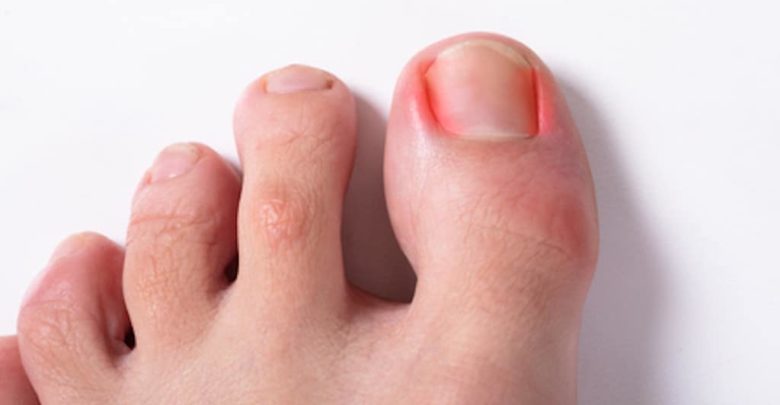 Ingrown Toenail Surgery