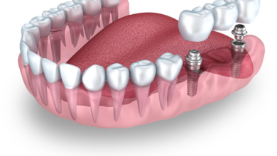 Tooth implant Singapore