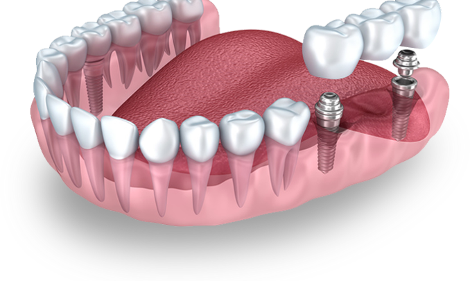 Tooth implant Singapore